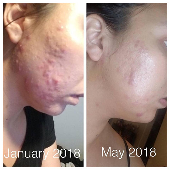 Super Acne Fighter / Organic Acne Treatment / Acne - Govis Bloom
