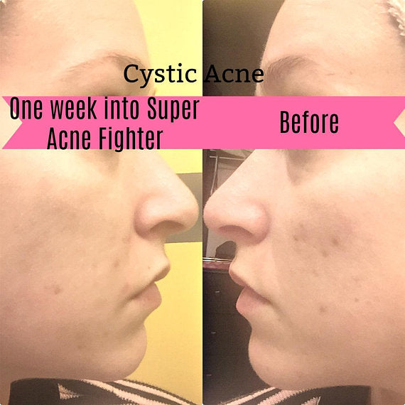 Super Acne Fighter / Organic Acne Treatment / Acne - Govis Bloom